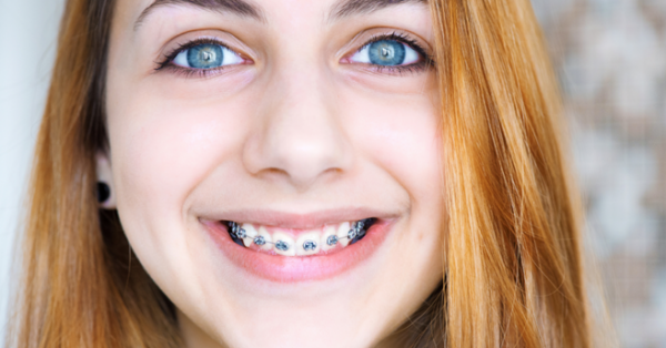 How to Tell When It’s Time For Braces
